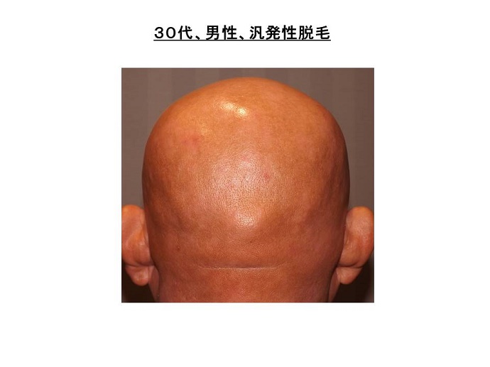 汎発性脱毛　病院""